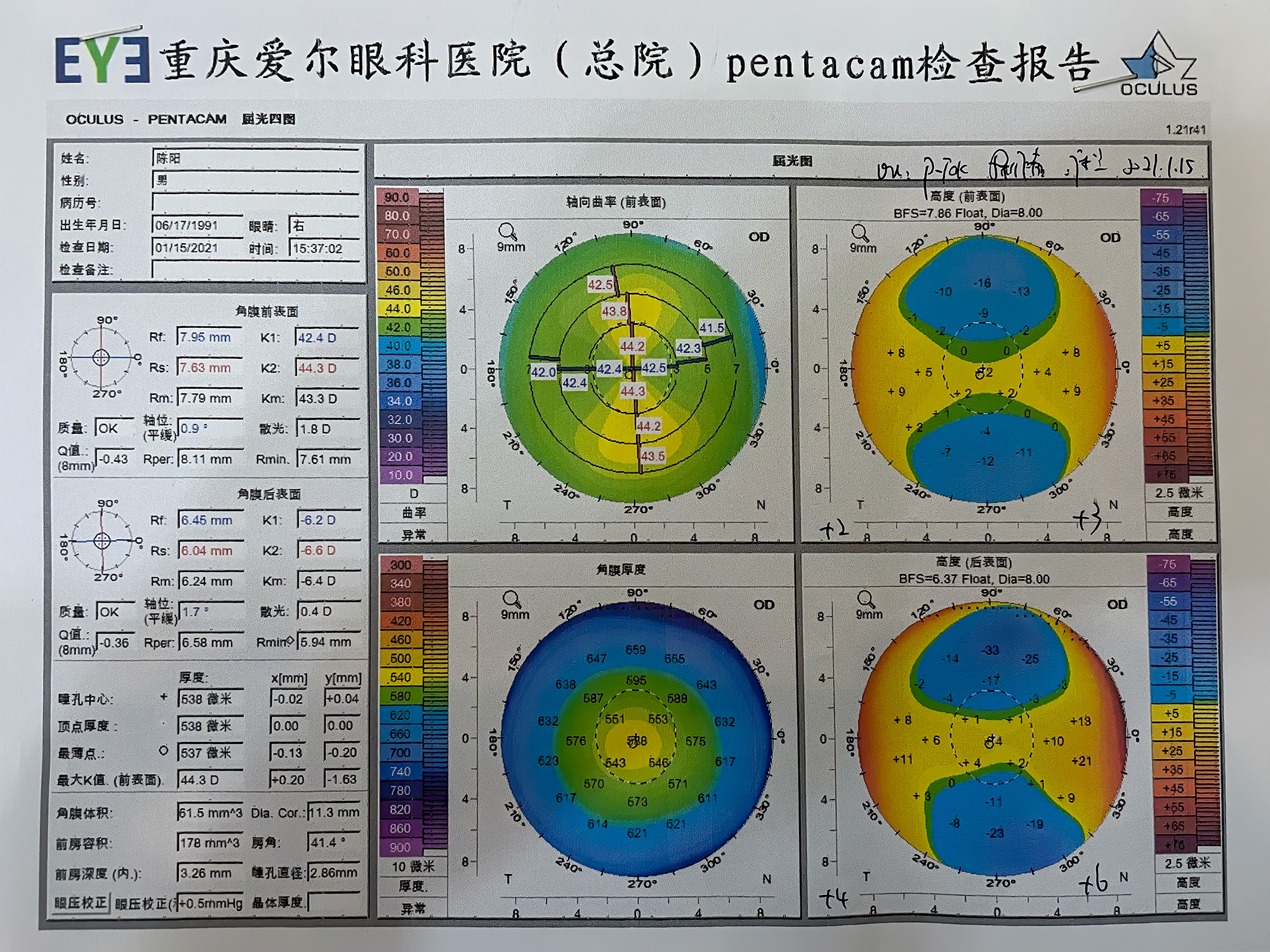 右眼角膜地图